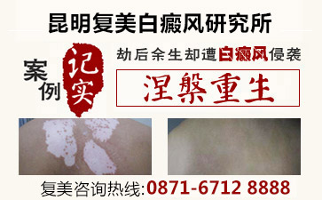 昆明复美白癜风医院